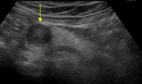 Benign Pancreatic Tumor Treatment in Electronic City